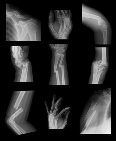 Hairline Fracture